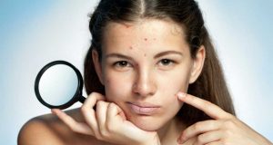 Acné : nos 5 recettes de masque pour en venir à bout ! recettes masque contre acné