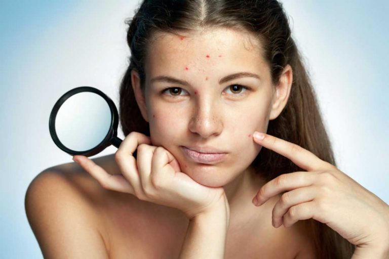 Acné : nos 5 recettes de masque pour en venir à bout !