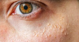 Grains de milium : 9 remèdes naturels pour les supprimer grains de milium