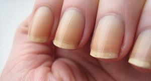 Ongles jaunis : tous nos conseils pour retrouver de beaux ongles ongles jaunis