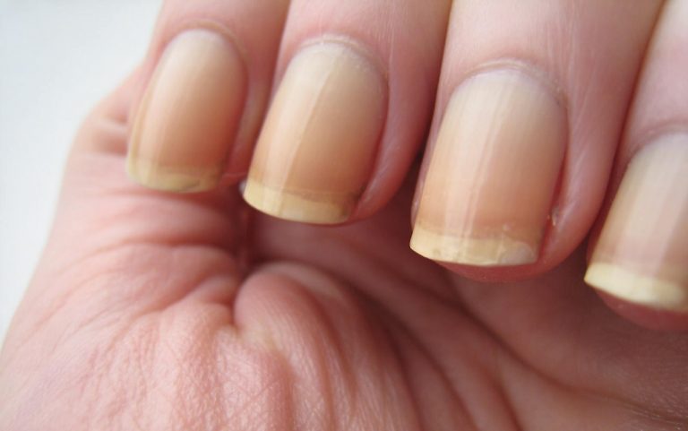 Ongles jaunis : tous nos conseils pour retrouver de beaux ongles