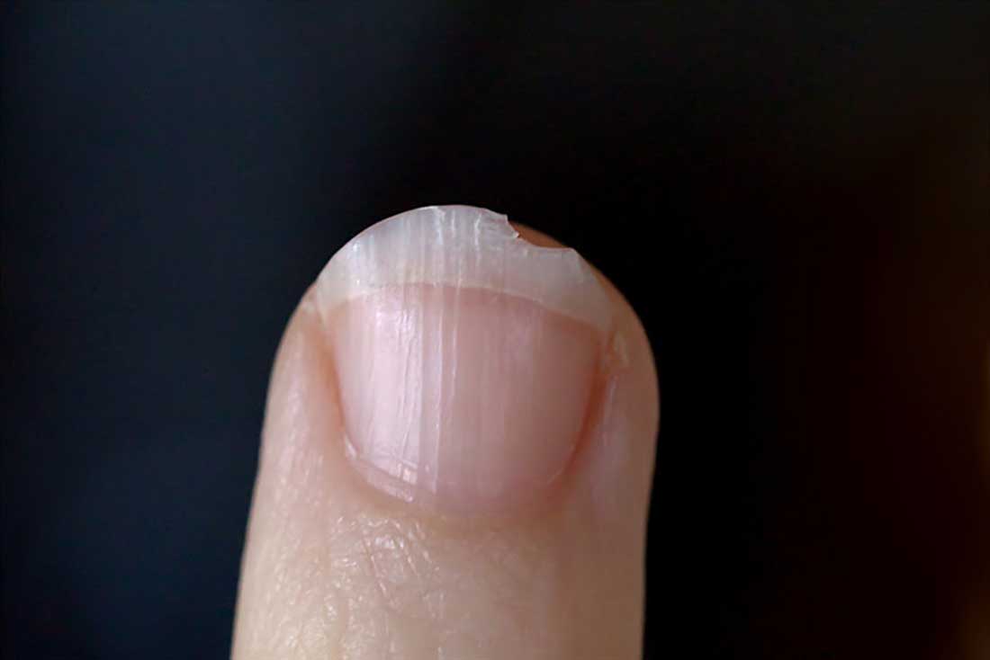 Ongles striés : Nos conseils pour les soigner