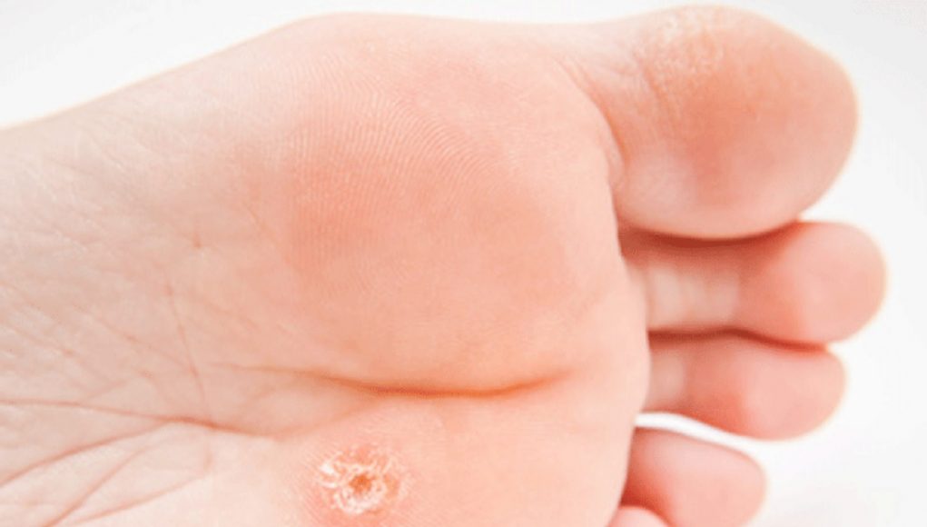 verrue plantaire verrue plantaire