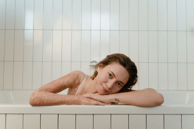Comment se débarrasser d&rsquo;une marque de brûlure sur la peau ?