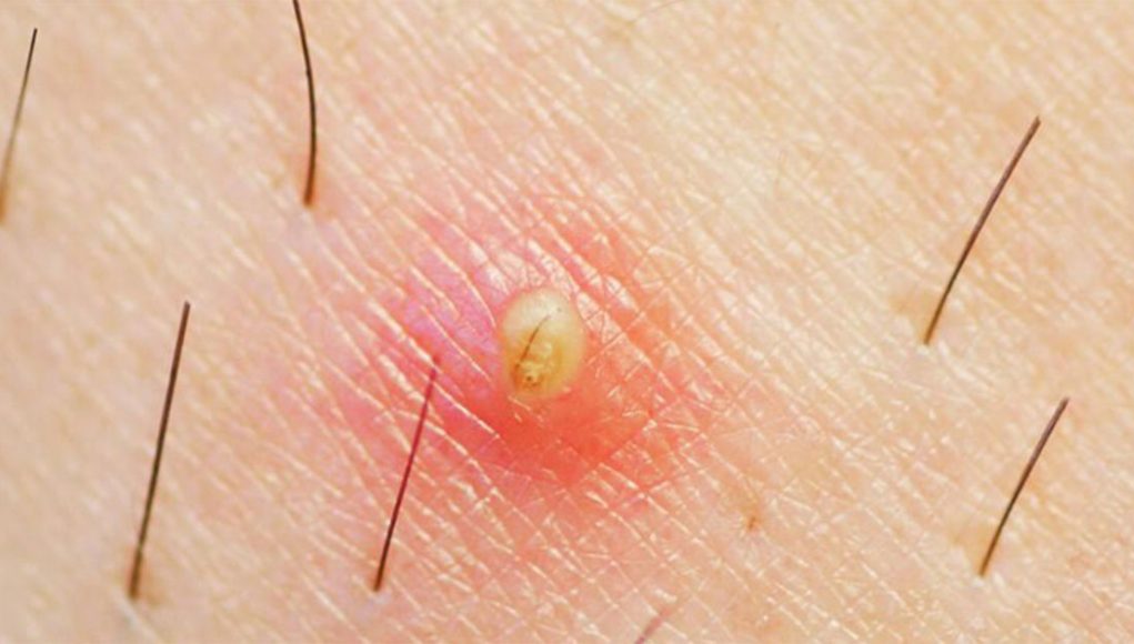 poils-incarnes Poils incarnés