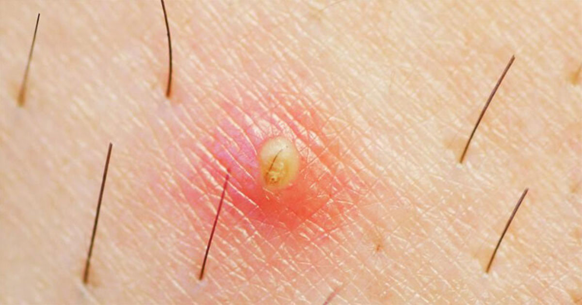 Poils incarnés : 3 conseils pour s’en débarrasser !