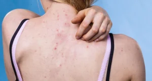 Acné dans le dos : 6 traitements efficaces acné dans le dos