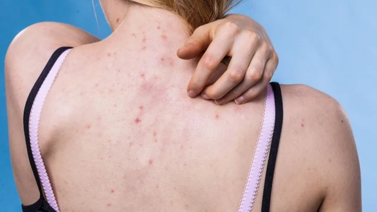 Acné dans le dos : 6 traitements efficaces