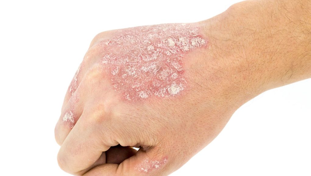 eczema-remedes remèdes naturels eczéma