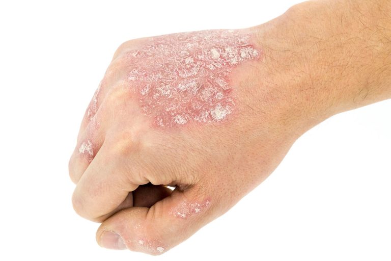Eczéma : 4 remèdes naturels efficaces