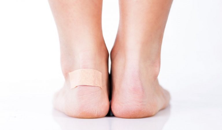 3 astuces pour soulager les ampoules au pieds