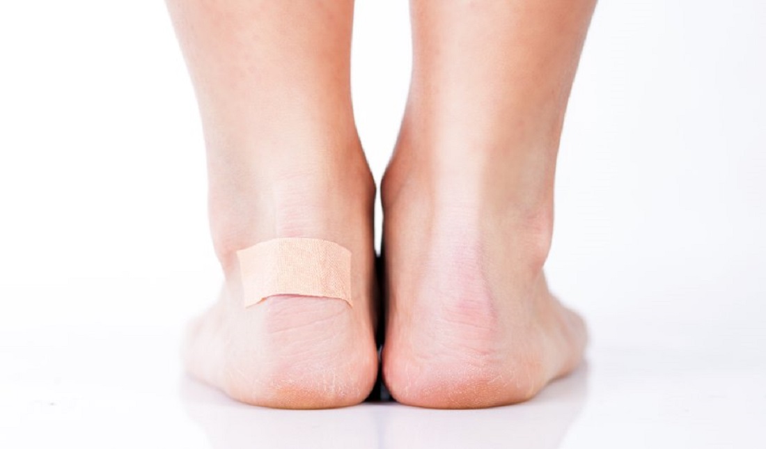 3 astuces pour soulager les ampoules au pieds