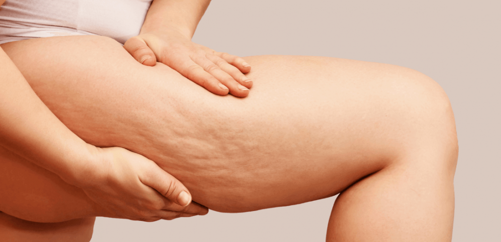 lutter contre la cellulite lutter contre la cellulite