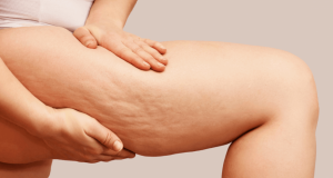 3 astuces pour lutter contre la cellulite ! lutter contre la cellulite