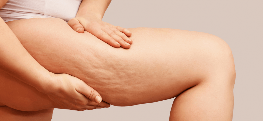 3 astuces pour lutter contre la cellulite !