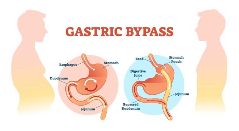 Bypass gastrique : découvrez les informations essentielles !