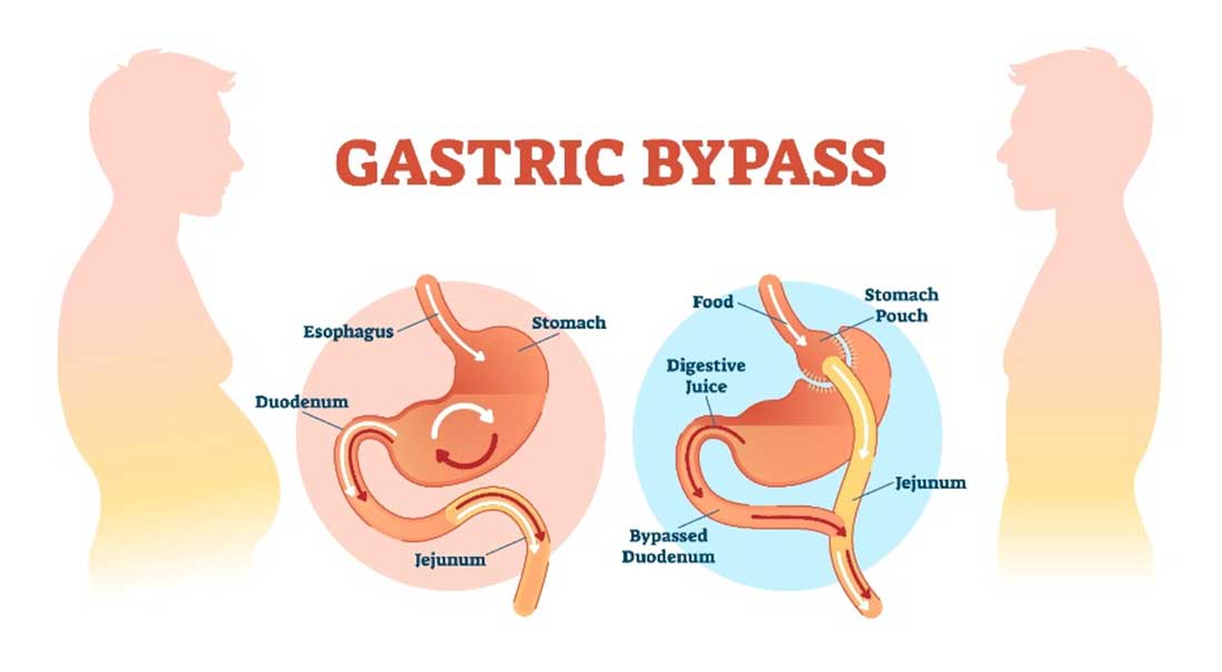Bypass gastrique : découvrez les informations essentielles !