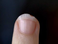 Ongles striés : Nos conseils pour les soigner ongles striés