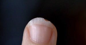 Ongles striés : Nos conseils pour les soigner ongles striés
