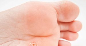 Verrue plantaire – 5 remèdes naturels verrue plantaire