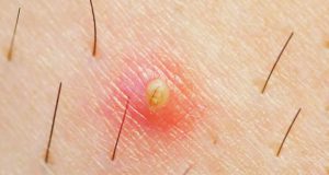 Poils incarnés : 3 conseils pour s’en débarrasser ! Poils incarnés