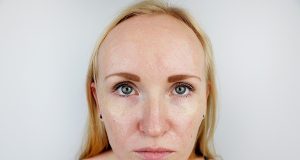 Ces aliments déconseillés pour la peau grasse aliments déconseillés pour la peau grasse