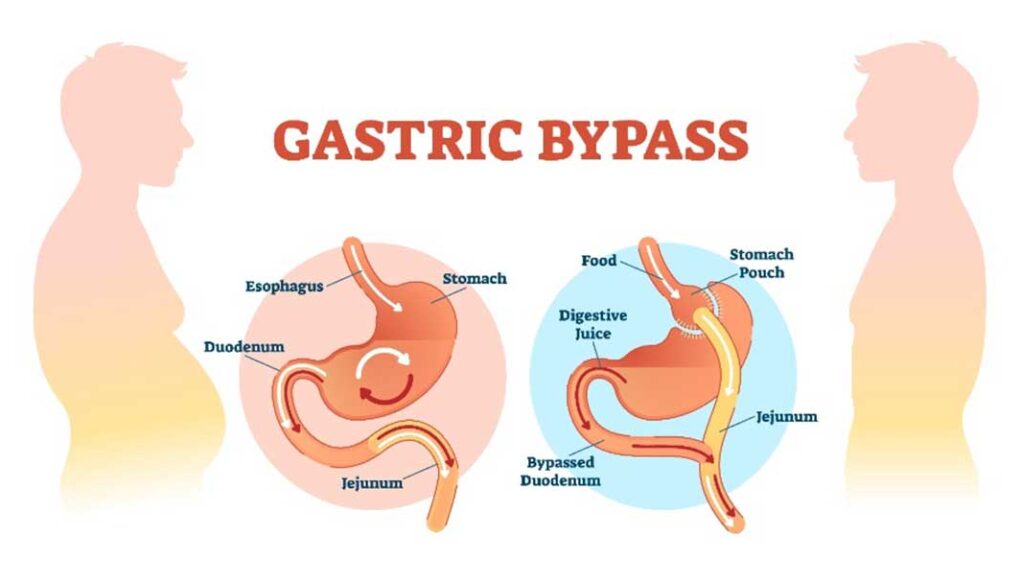 Bypass gastrique