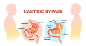 Bypass gastrique : découvrez les informations essentielles ! Bypass gastrique